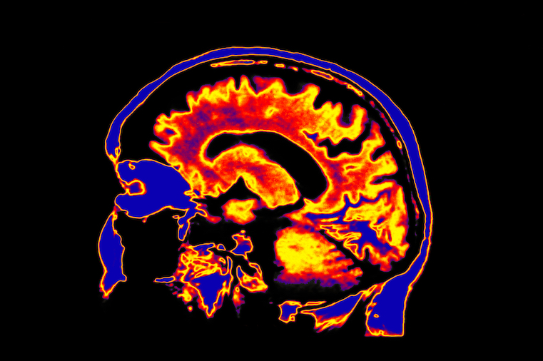 Hacking Stress in the Digital Age: What Brain Scans and Wearables Reveal