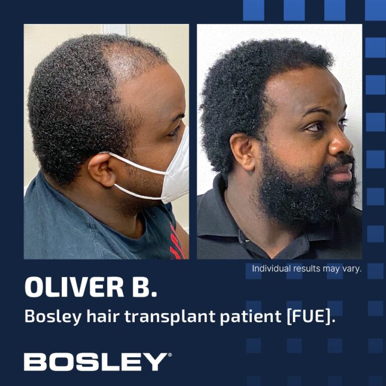 Bosley Hair Review: My Comprehensive Take on Their Treatments, Products, and Results