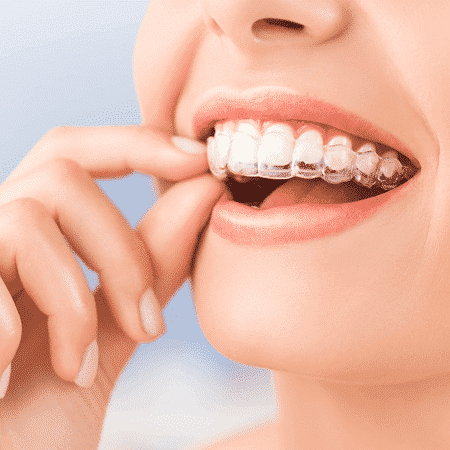 AlignerCo Review: The Honest Truth About These Affordable Clear Aligners