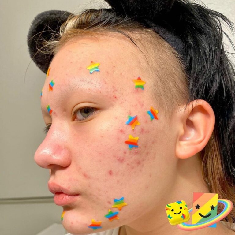 Starface Review: The Acne Care Brand Making Breakouts a Little More Bearable